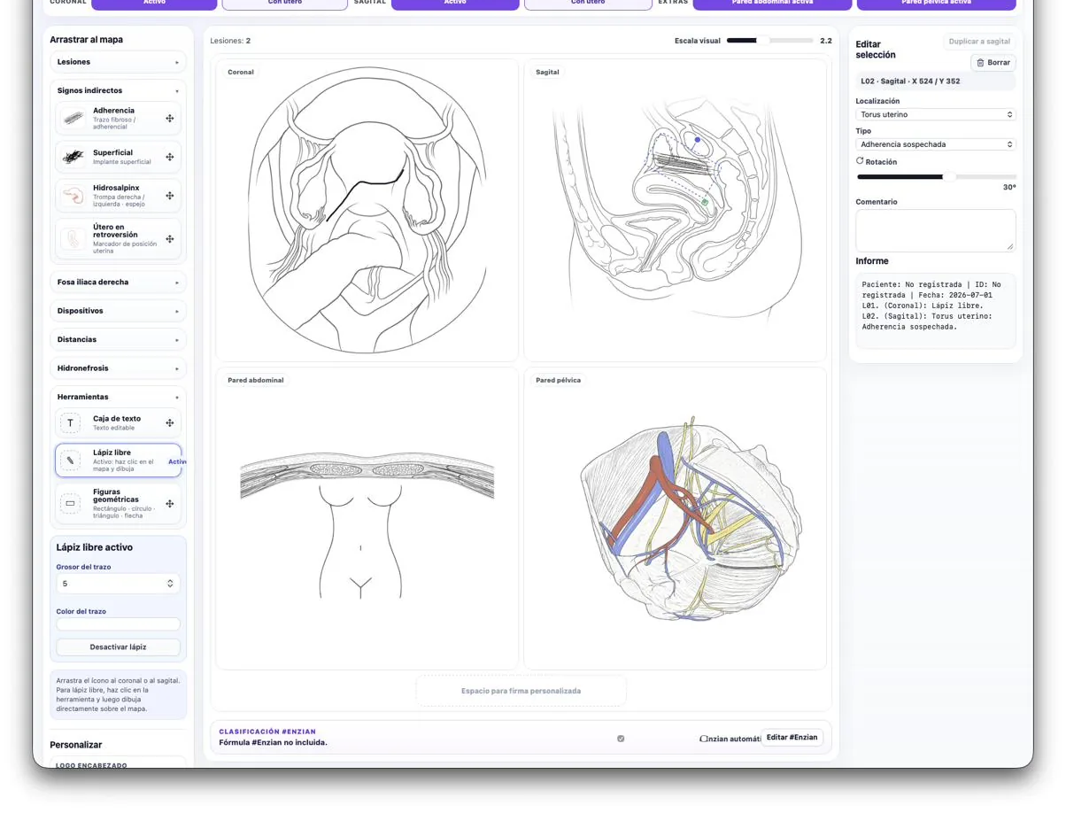 Esquemas coronal, sagital, pared abdominal y pared pélvica